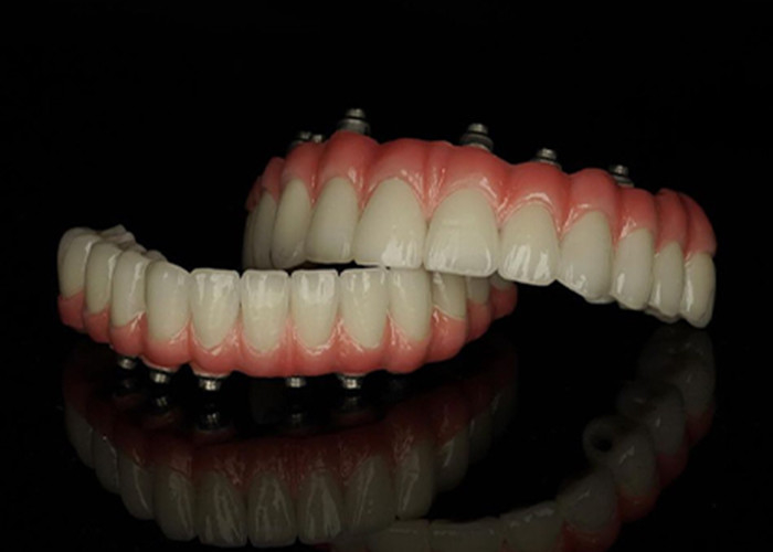 Titanium Base  Fixt Implant supported dentures with Ceramic Crown Bridge For Replacing Missing Teeth