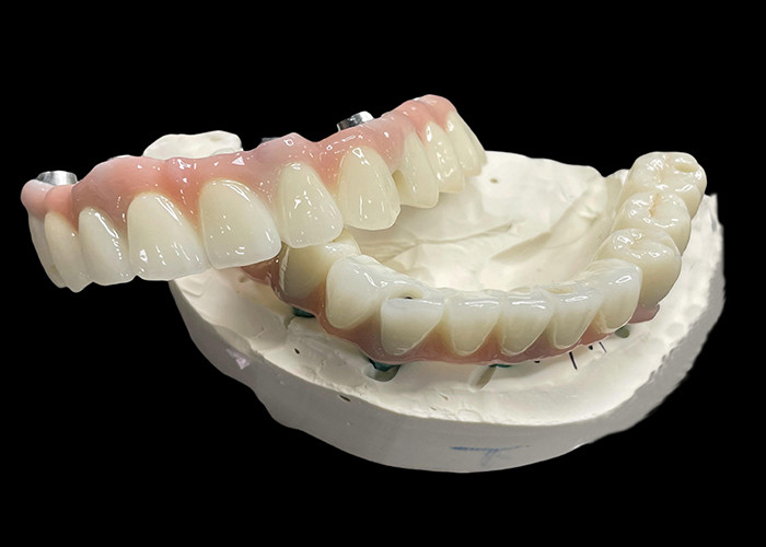 Titanium Base  Fixt Implant supported dentures with Ceramic Crown Bridge For Replacing Missing Teeth