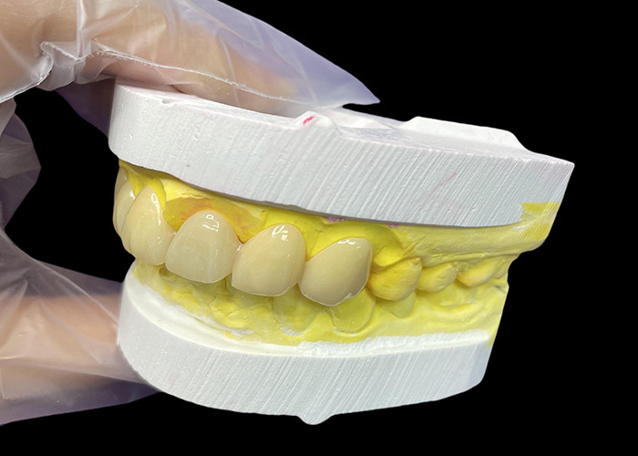 Cosmetic Vita Classical Shade Ceramic Crowns and Bridges with Precise Fit Natural Look and Customizable Options