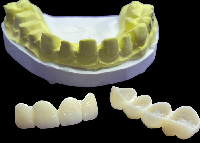 Stain Resistant Dental Porcelain Crowns and Bridges in Vita Classical Shades for Natural Aesthetics