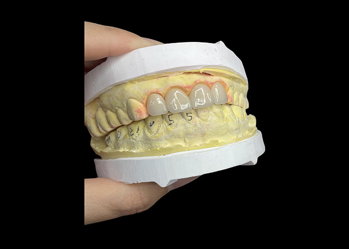 Stain Resistant Dental Porcelain Crowns and Bridges in Vita Classical Shades for Natural Aesthetics