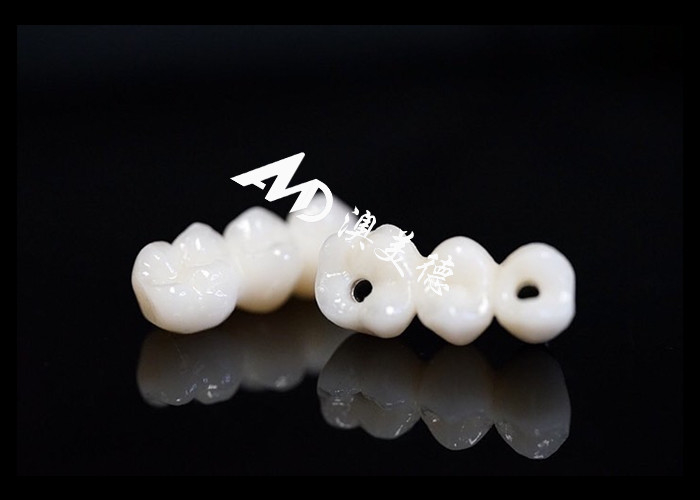Natural Looking Dental Implant Crown bridge Fixed with Titanium abutment for Missing Teeth Surgery