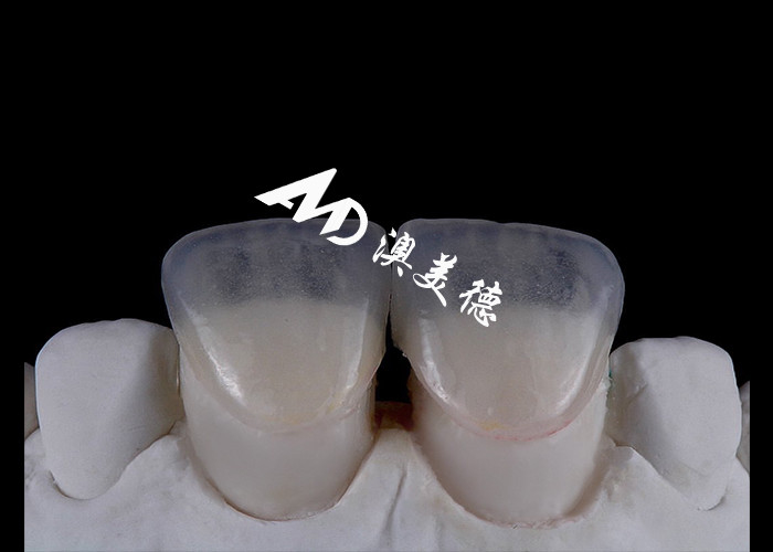 Transform Your Smile with IPS emax Press Porcelain Veneers Strength Aesthetics and Durability Combined