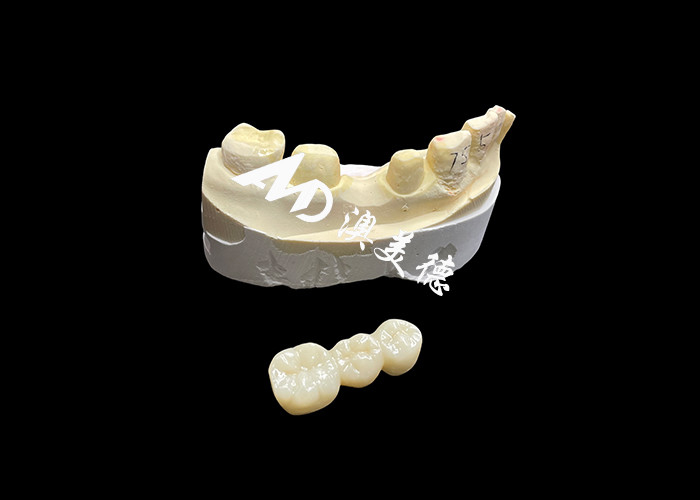 High-Hardness Aesthetic Zirconia Dental Crown with Translucency and Chipping Resistance from China dental Lab
