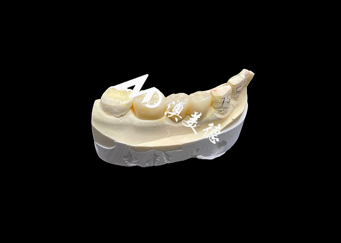 High-Hardness Aesthetic Zirconia Dental Crown with Translucency and Chipping Resistance from China dental Lab