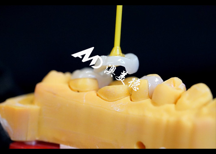 Precision Ceramic Inlays and Onlays for Teeth Repair with Natural Color Hypoallergenic Material and Seamless Fit for Superior Comfort and Durability