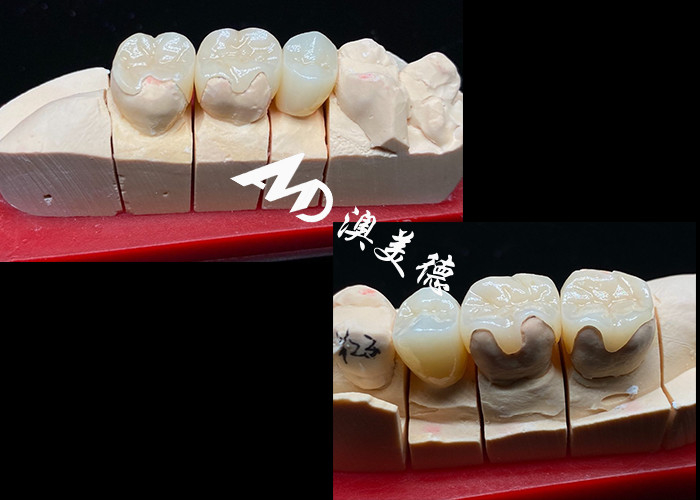 OEM Precision Fit Ceramic Inlays Onlays for Durable and Natural-Looking Dental Restorations with Superior Strength and Reliability