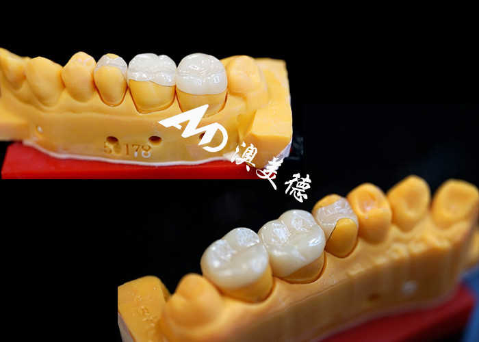 OEM Precision Fit Ceramic Inlays Onlays for Durable and Natural-Looking Dental Restorations with Superior Strength and Reliability