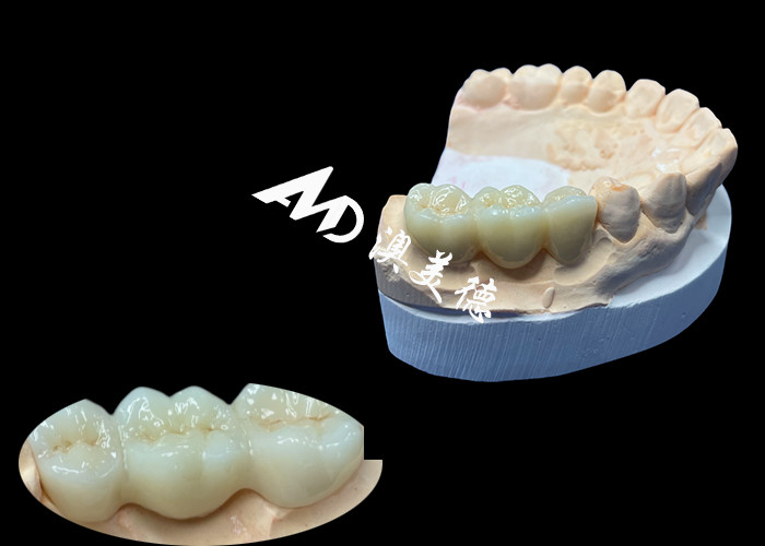 Natural Color Zirconia Dental Crown Crack Resistant For A Flawless Smile from China Dental Lab