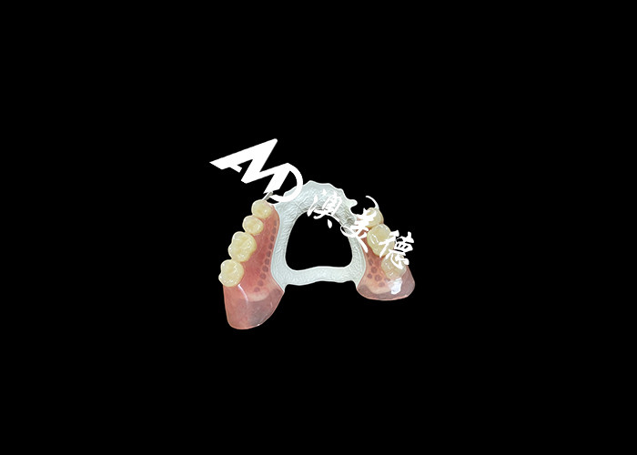High-Quality Removable Denture with Durable HPP Framework and Comfortable Acrylic Base for a Secure Fit and Long-Lasting Performance