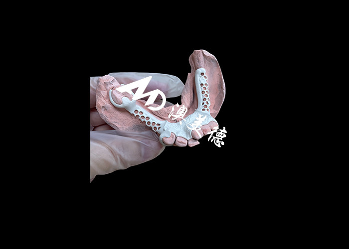 Removable Denture with HPP Frame and Acrylic Base for Enhanced Durability and Comfort