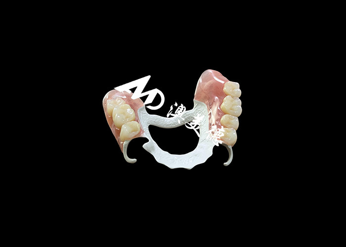 Removable Denture with HPP Frame and Acrylic Base for Enhanced Durability and Comfort