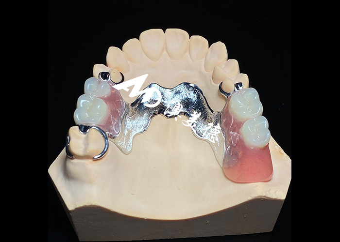 Removable Denture with Cast Metal Framework for Superior Strength and Stability with Long Lasting Comfort
