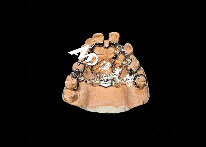 Removable Denture with Cast Metal Framework for Superior Strength and Stability with Long Lasting Comfort