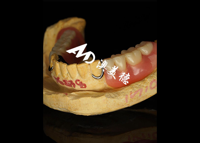 Removable Denture with Cast Metal Framework for Superior Strength and Stability with Long Lasting Comfort