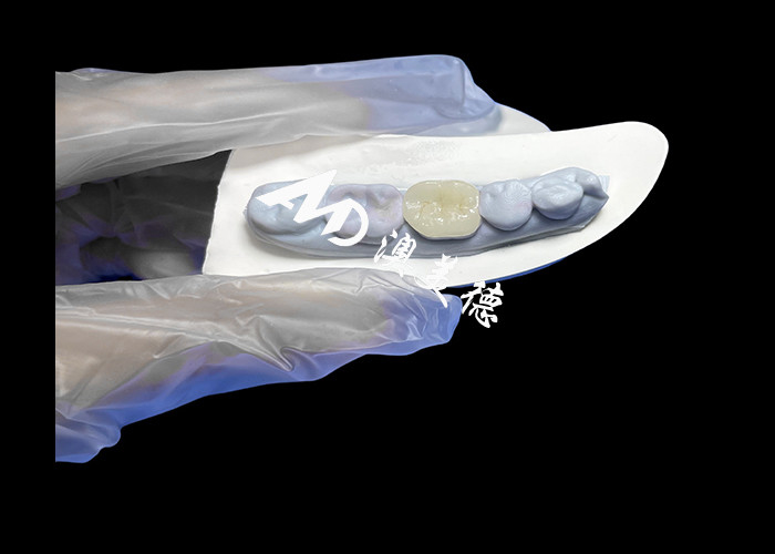High-Quality Ceramic Inlays and Onlays for Seamless and Long-Lasting Tooth Restoration