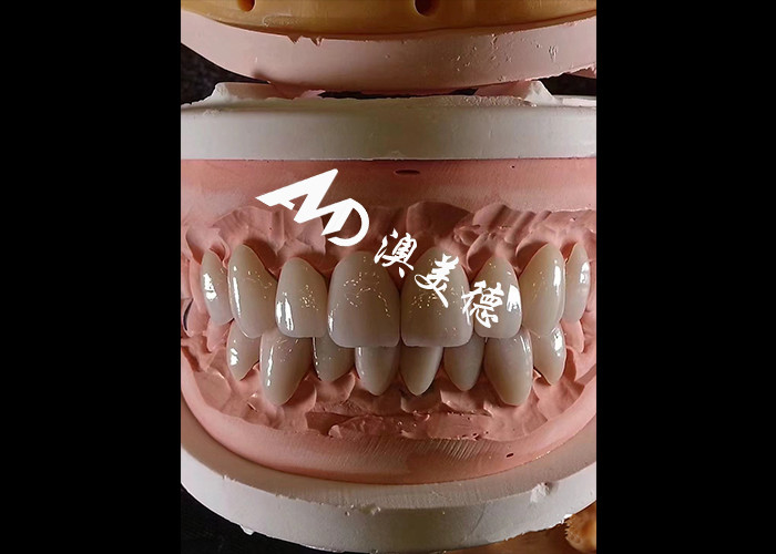 Cosmetic Dentistry EMAX Dental Veneers 0.3-0.5mm Thick For Esthetic Restorations