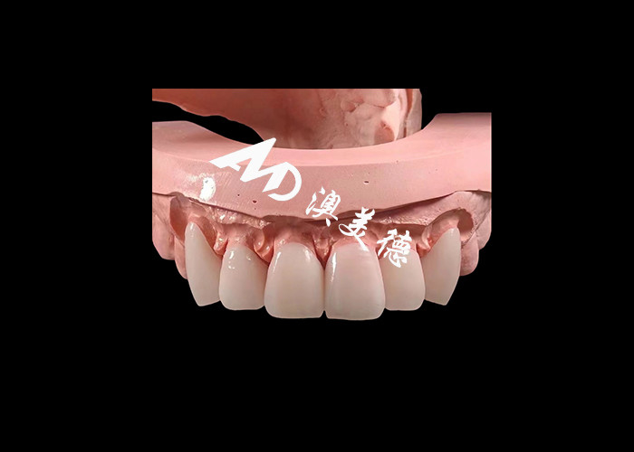 Cosmetic Dentistry EMAX Dental Veneers 0.3-0.5mm Thick For Esthetic Restorations