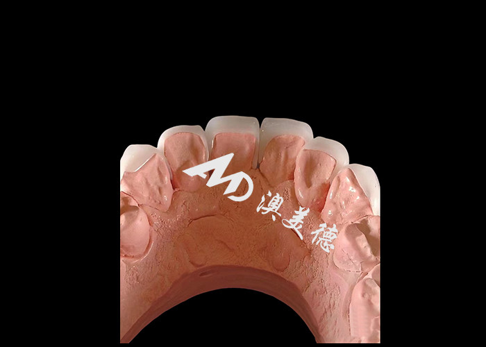 Cosmetic Dentistry EMAX Dental Veneers 0.3-0.5mm Thick For Esthetic Restorations