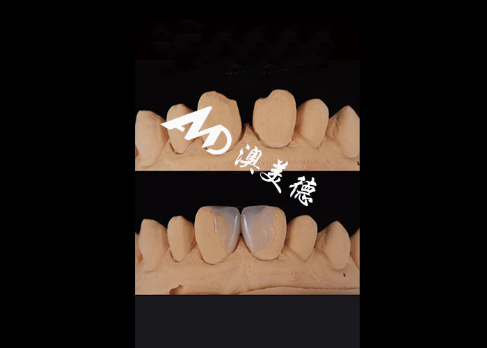 0.3-0.5mm Ultra thin IPS EMAX Porcelain Veneers for Esthetic Smile Makeovers