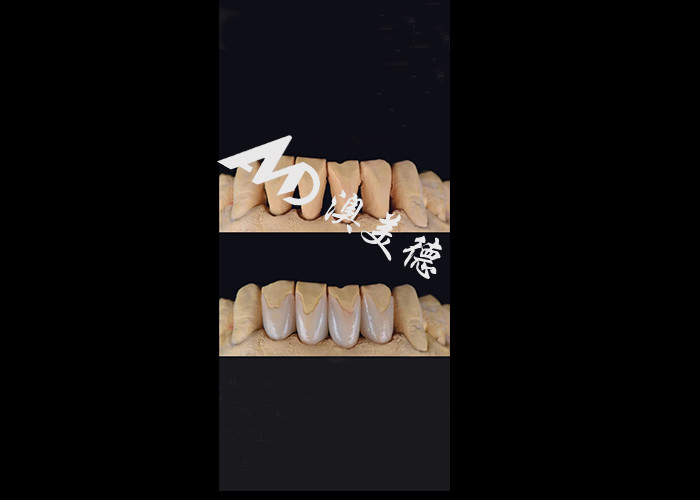 0.3-0.5mm Ultra thin IPS EMAX Porcelain Veneers for Esthetic Smile Makeovers