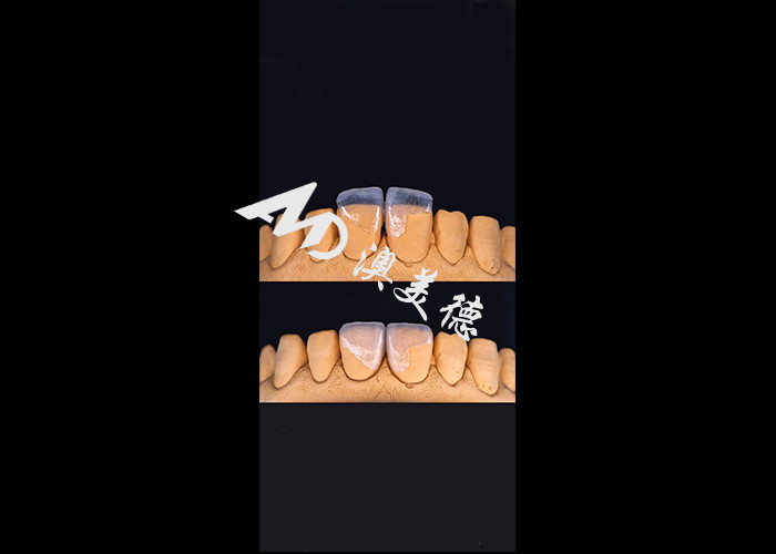 0.3-0.5mm Ultra thin IPS EMAX Porcelain Veneers for Esthetic Smile Makeovers