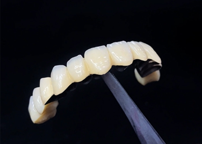 Porcelain Fused To Metal Crown Combining Durability And Beauty For Dental Health