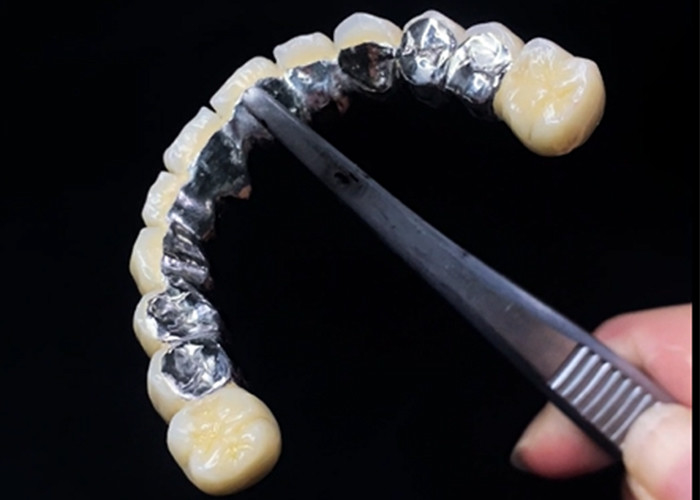 Porcelain Fused To Metal Crown Combining Durability And Beauty For Dental Health