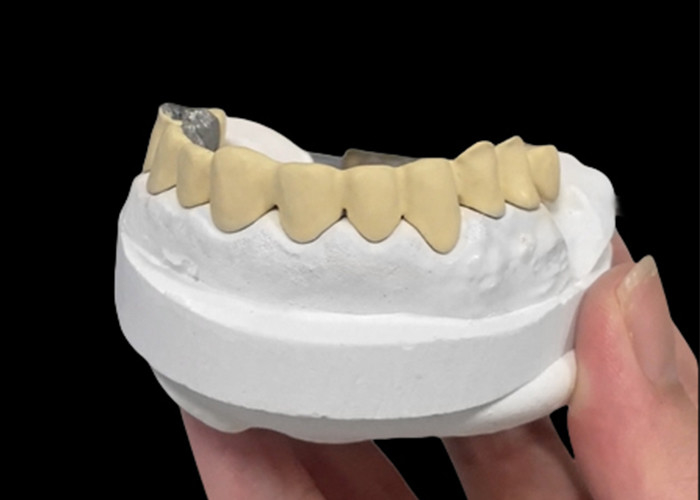 Porcelain Fused To Metal Crown Combining Durability And Beauty For Dental Health