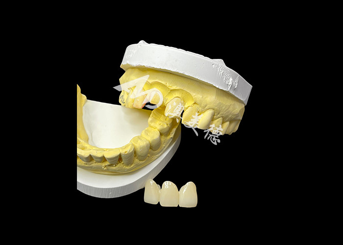 Upgrade Your Dental Aesthetics with a Ceramic Crown Bridge that Combines Exceptional Aesthetics and Outstanding Biocompatibility for a Natural, Comfortable Smile