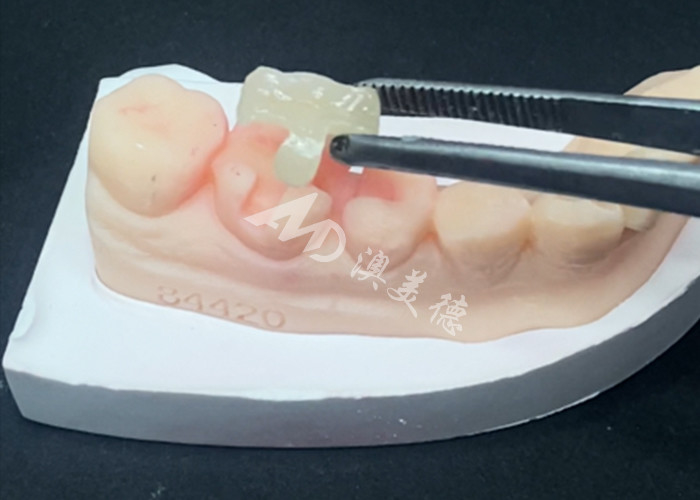 Emax Ceramic Inlays Onlays Dental Restorations For Natural Tooth Color And Easy Maintenance