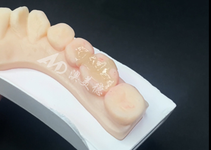 Emax Ceramic Inlays Onlays Dental Restorations For Natural Tooth Color And Easy Maintenance