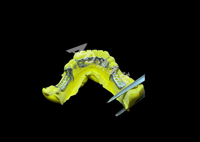 Tailored Cast Partial Denture with Personalized Aesthetics and Secure Fit for Enhanced Comfort and Functionality