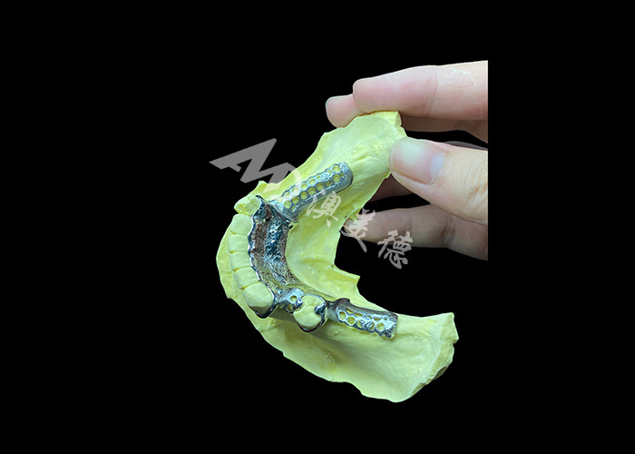 Tailored Cast Partial Denture with Personalized Aesthetics and Secure Fit for Enhanced Comfort and Functionality
