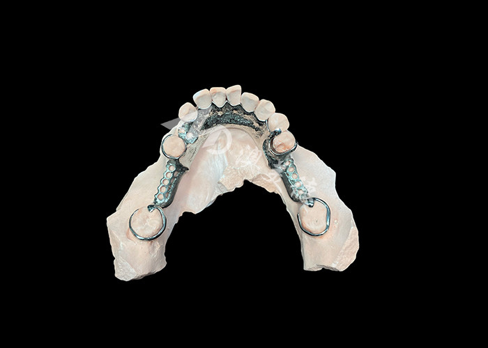 Tailored Cast Partial Denture with Personalized Aesthetics and Secure Fit for Enhanced Comfort and Functionality