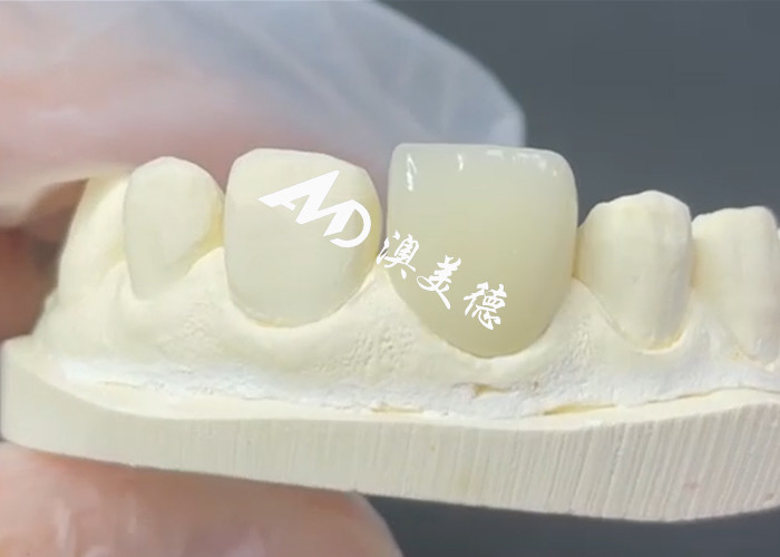 Durable and Aesthetic EMAX Veneer The Perfect Solution for Porcelain Restorations