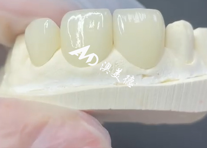 Durable and Aesthetic EMAX Veneer The Perfect Solution for Porcelain Restorations
