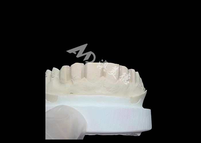 IPS Emax Veneers Minimal Prep/ No-prep Veneers Are Innovative Solutions For Beautiful Smile