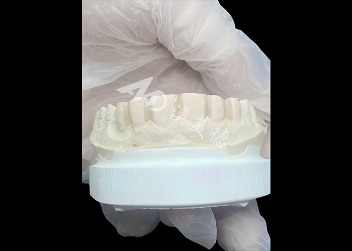 IPS Emax Veneers Minimal Prep/ No-prep Veneers Are Innovative Solutions For Beautiful Smile