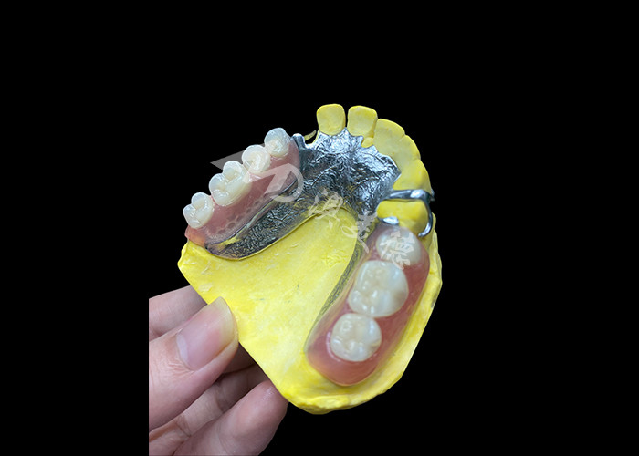 Adjustable Cast Partial Dentures for Enhanced Comfort and Stability, Perfect for Chewing and Speaking Needs