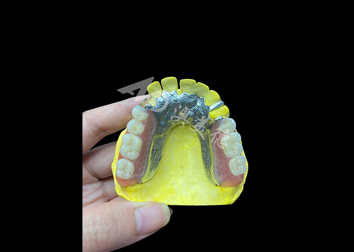 Adjustable Cast Partial Dentures for Enhanced Comfort and Stability, Perfect for Chewing and Speaking Needs