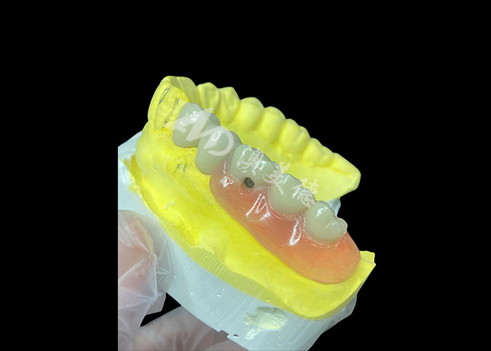 Personalized PFM+Removable Dentures combo The Ultimate Solution for Comfort and Aesthetics