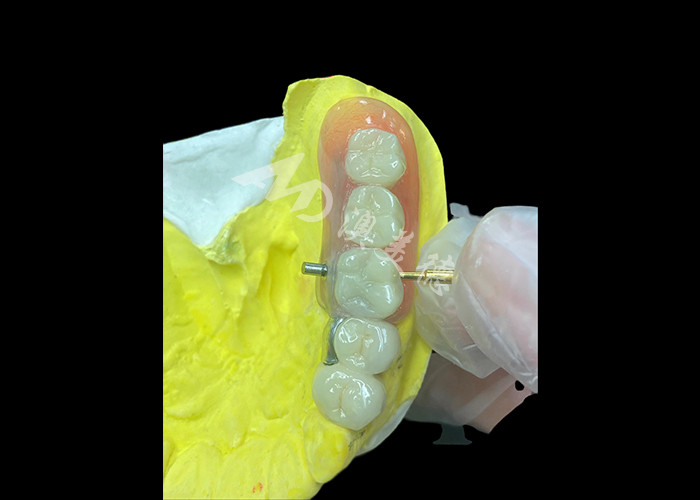 Personalized PFM+Removable Dentures combo The Ultimate Solution for Comfort and Aesthetics