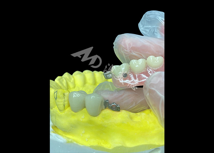 Personalized PFM+Removable Dentures combo The Ultimate Solution for Comfort and Aesthetics