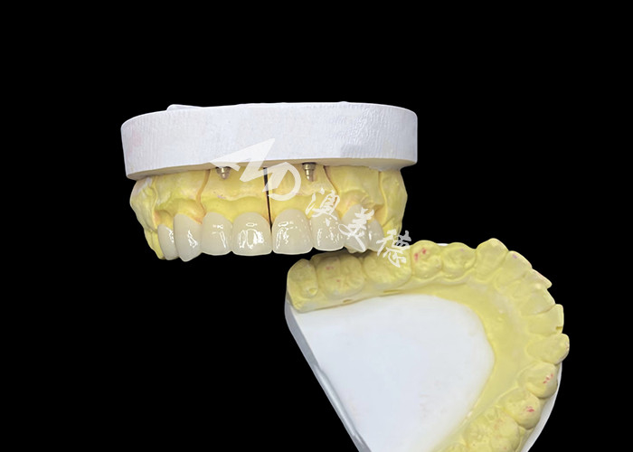 Achieve a Perfect Smile with High Quality Ceramic Dental Crowns for Natural Appearance and Durable Strength