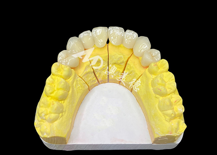 Achieve a Perfect Smile with High Quality Ceramic Dental Crowns for Natural Appearance and Durable Strength