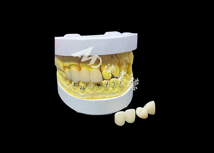 Achieve a Perfect Smile with High Quality Ceramic Dental Crowns for Natural Appearance and Durable Strength