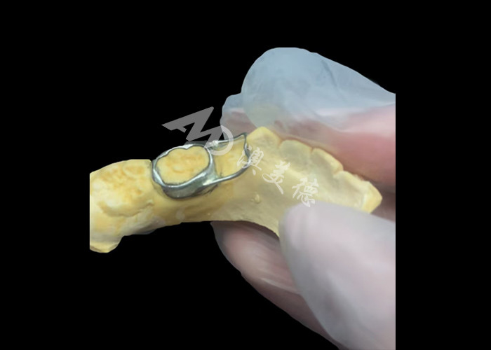 Orthodontic Space maintainer an invaluable device ingeniously guarding children's tooth gaps ensuring proper tooth development.