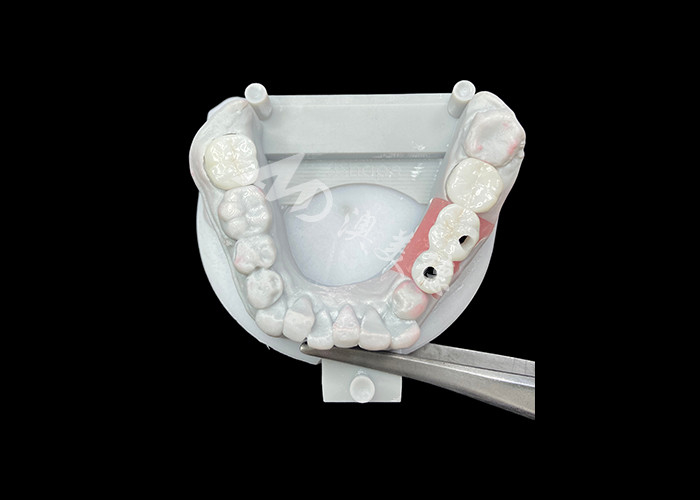 Zirconia Dental Implant Crowns With Titanium Abutment For Enhanced Comfort And Aesthetics