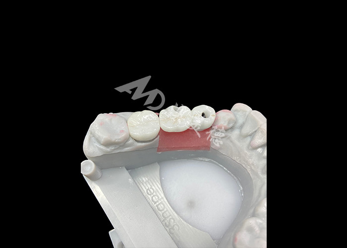 Zirconia Dental Implant Crowns With Titanium Abutment For Enhanced Comfort And Aesthetics